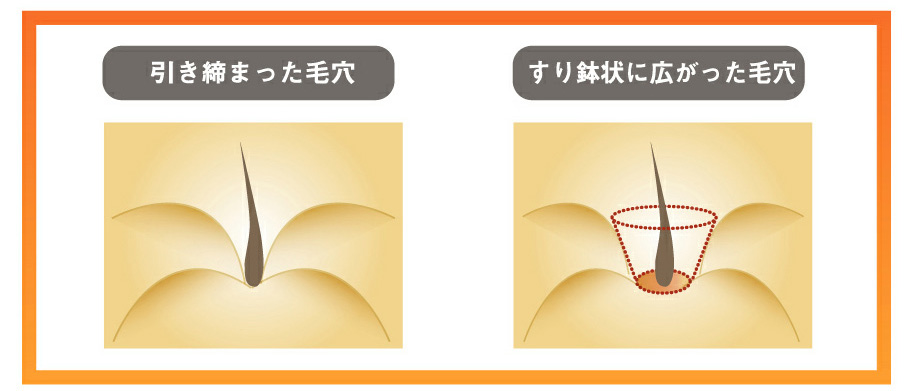 引き締まった毛穴
すり鉢状に広がった毛穴